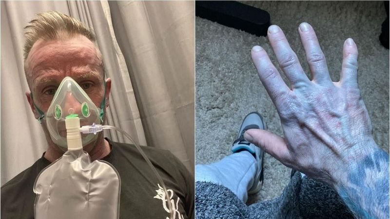 Rejtélyes kék bőr: a brit férfi esete, ami mindenkit megdöbbentett