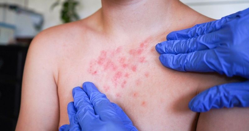 Rühjárvány söpör végig a Balkánon: elit iskolák és gyárak is veszélyben