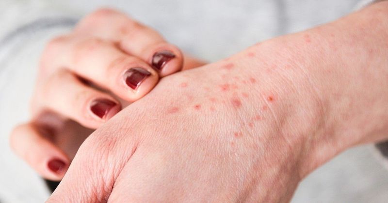 Ártalmatlannak tűnő bőrkiütés, komoly bajt jelezhet: mikor kell orvoshoz fordulni?