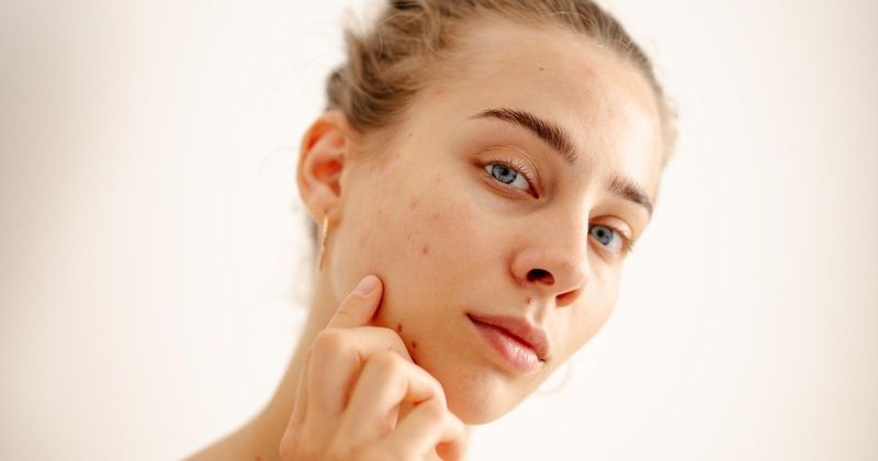 5 meglepő módszer, amivel megszabadulhatsz a hátadon lévő pattanásoktól