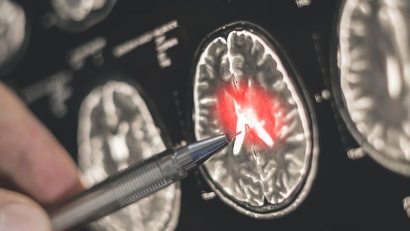 A Parkinson-kór világnapja apropóján: mire figyelj, ha a tünetek jelentkeznek?