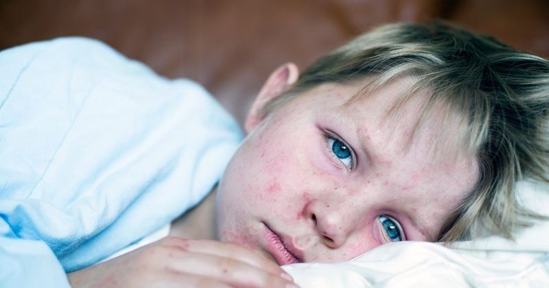 Kanyaróárnyék vetül Londonra: Drámai növekedés a gyermekek körében