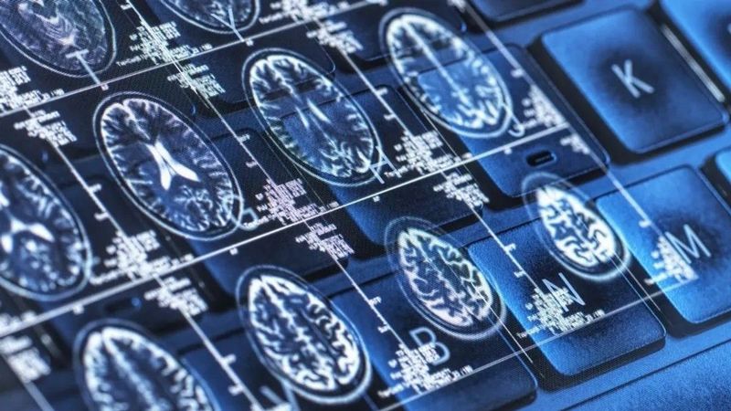 Új összefüggést találtak az Alzheimer és bizonyos betegségek között, a kutatók is meglepődtek